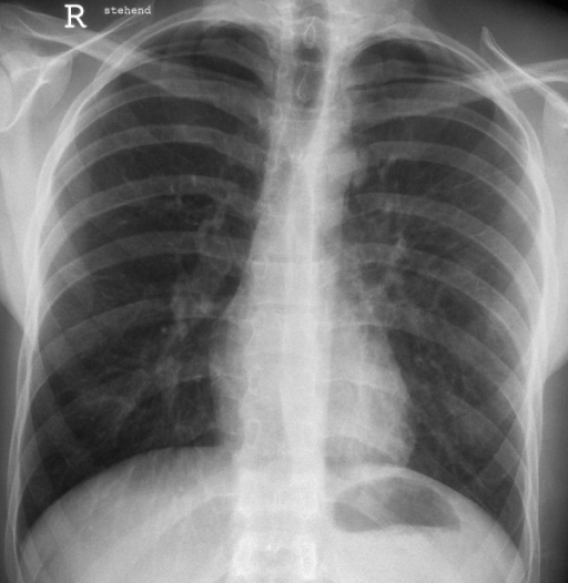 Chest radiography with reexpanded left lung and decreas | Open-i