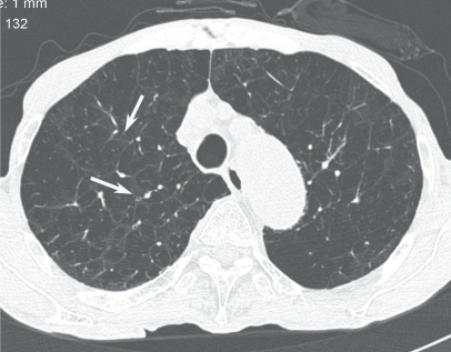 Advanced centriacinar emphysema. It is very difficult t | Open-i