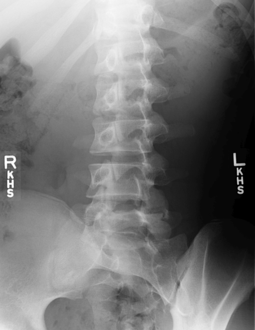 Right oblique image of L5 Spondylolysis | Open-i