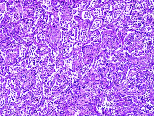 Microscopic shape of the lung showing proliferative pha | Open-i