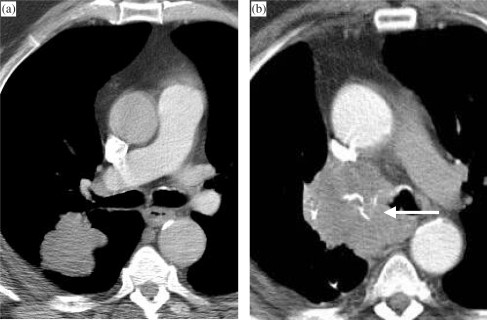 Bronchial stump recurrence following right upper and mi | Open-i