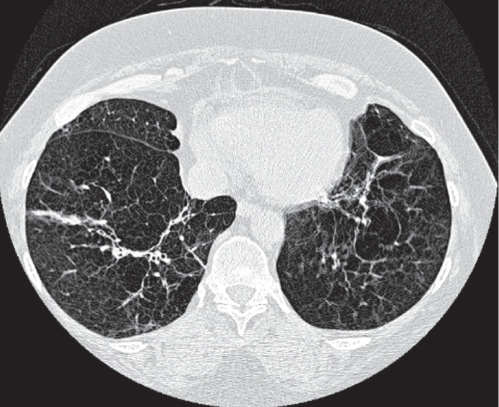 CT scan of the chest demonstrating severe emphysematous 