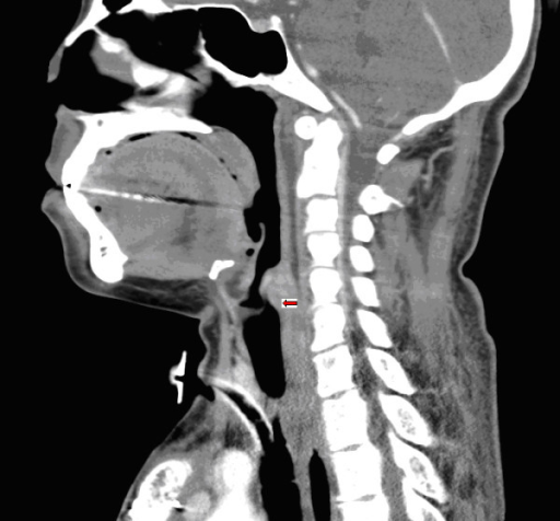Sagittal And Coronal View Of The Ct Scan Showing A Shor Open I