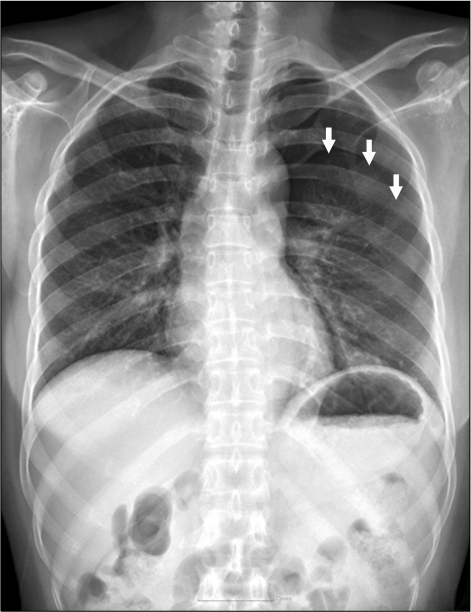 Initial Chest X Ray Shows Pneumothorax In Left Hemithor Open I