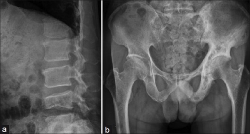 A Compression Fracture Of The L4 Vertebral Body And M Open I 1687