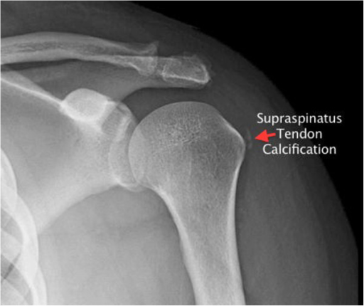 Plain film radiograph of the proximal humerus with supr | Open-i