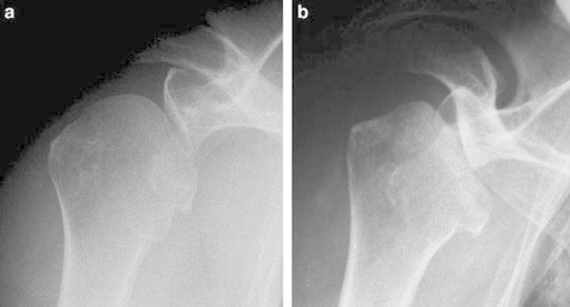 Serial preoperative radiographs of case 2. Flattening o | Open-i