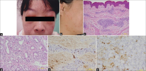 Clinical feature and histopathological examination of the patients (a) Swelling of bilateral upper eyelids. (b) Erythematous papular skin lesions on the right cheek. HE histopathological examination of skin lesion (c) salivary gland (d) fibrosis and infiltration of lymphocytes and plasma cells. Immunohistochemical examination of skin lesion (s) salivary gland (f) infiltration of IgG4 positive plasma cells