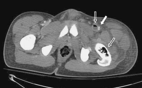 CT scan of abdomen  and pelvis with contrast demonstrati 