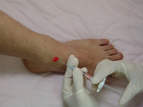 Ankle Joint Injection | Open-i