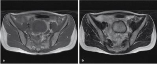 Pelvic MRI findings. a T1-weighted MRI shows the tumor | Open-i