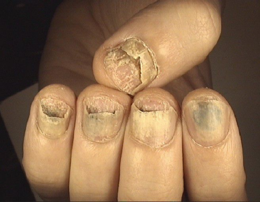 Severe onycholysis with distal to proximal detachment o | Open-i