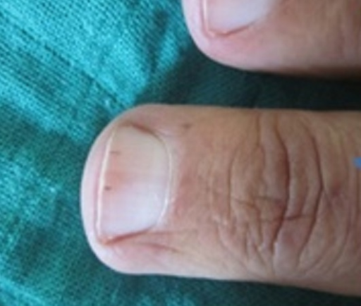 Urgent advice required, mark on husbands nail. Is it melanoma? | Mumsnet