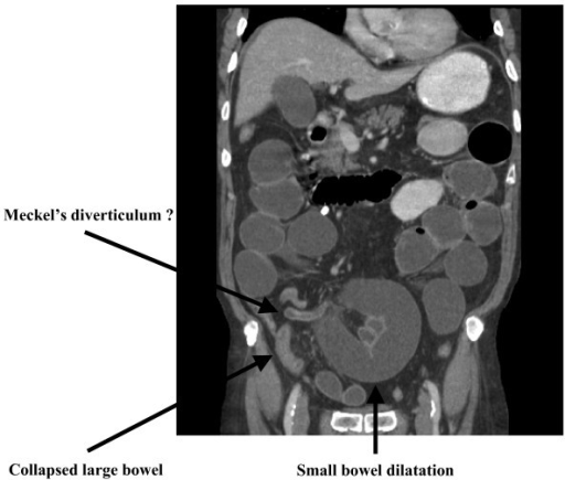 Reconstructed Computed Tomography Coronal Scan Of The A Open I