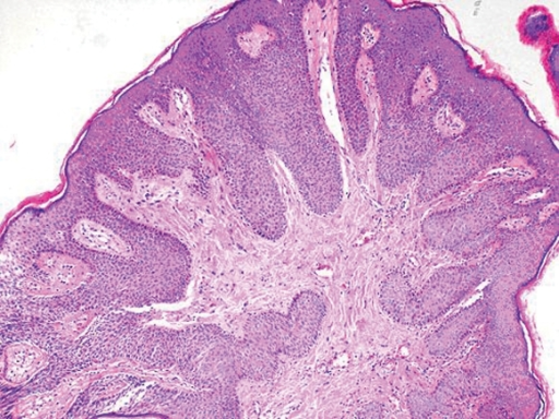 Histological Section Under Low Power Showing Condyloma | Open-i