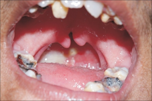 Bifid uvula, crowding of teeth | Open-i