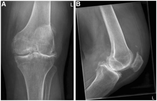 An X-ray Of The Left Knee Showed Severe Osteoarthritis | Open-i