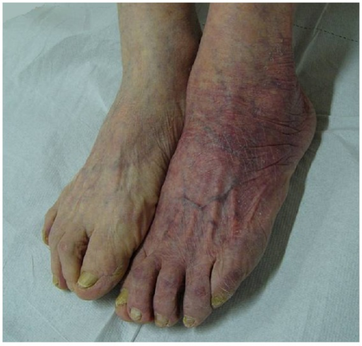 acrodermatitis chronica atrophicans