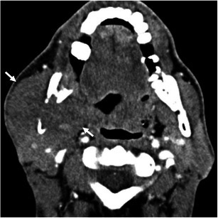 A 42-year-old man with undifferentiated sarcoma of the | Open-i