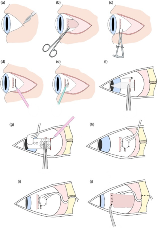 Surgical implantation of suprachoroidal retinal prosthe | Open-i