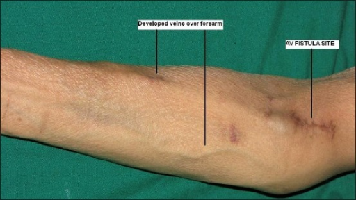 Well-developed forearm veins in proximal arteriovenous | Open-i