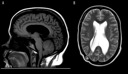 Brain MRI Without Contrast. (A) Sagittal T1; (B) Axial | Open-i