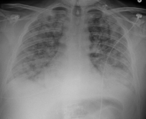 Chest radiograph showed bilateral pulmonary infiltrates | Open-i