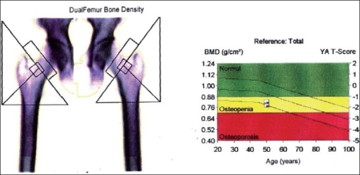DEXA report - Dual femur bone density study group | Open-i