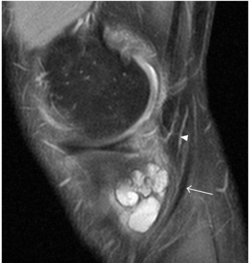 Pes Anserine Bursitis Sagittal Proton Density Fat Satu Open I Porn Hot Sex Picture