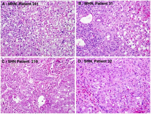 Histopathologic Features Of Hbv Associated Acute Liver Open I