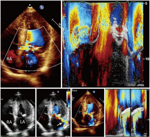 Two-dimensional echocardiography, M mode and color Dopp | Open-i