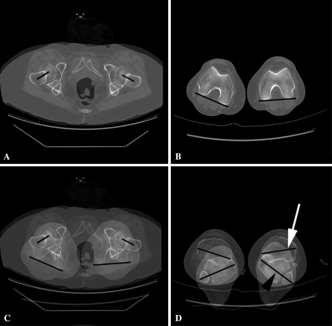 anteversion rotational femoral torsion ct femur tibial angle head scan 2009 fig7 policy copyright alignment distal open