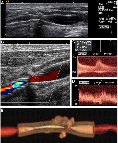 In-stent restenosis after carotid artery stenting as di | Open-i