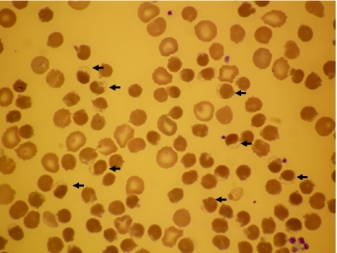 Peripheral blood film showing abundant hemighost cells | Open-i