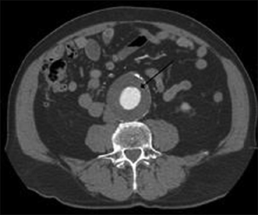 MRI abdomen depicting 4.5 cm abdominal aortic aneurysm | Open-i