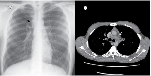 (A) Chest X-ray, posteroanterior view, showing a widene | Open-i