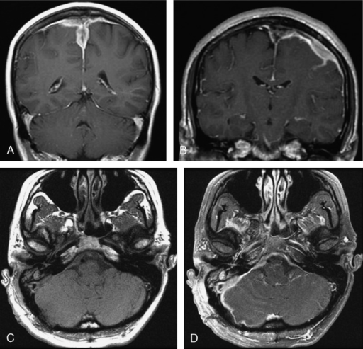 MRI findings of IgG4-related pachymeningitis. A. (Case | Open-i