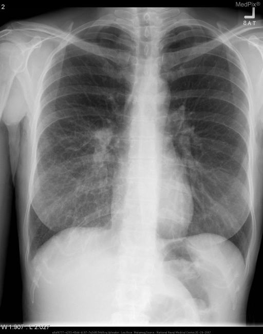 Chest x-ray shows increased interstitial markings in the right lower lobe.