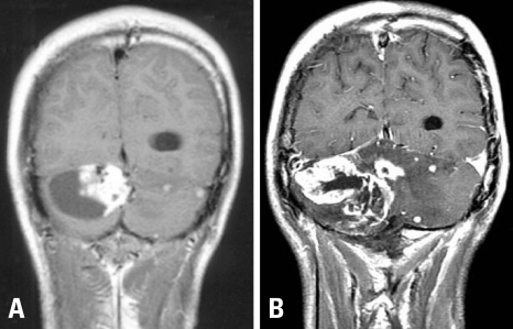 Initial brain MRI reveals a 4×4.5×6 cm-sized cystic m | Open-i