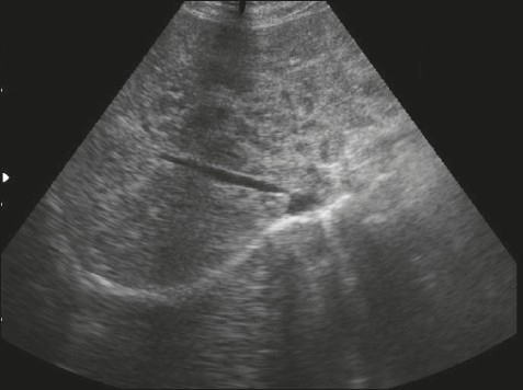 Ultrasound of the liver shows heterogenous echogenicity | Open-i