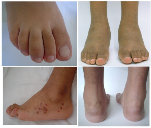Involvement of the feet in patients with SpA. A. Dactylitis of the third digit in a 12-year-old boy with undifferentiated SpA. B. Diffuse swelling of the tarsal region of a 11- year-old boy with juvenile-onset AS. C. Tarsal swelling, hyperextension of the digits, and keratoderma blenorrhagica spots in a 16-year-old boy with chronic reactive arthritis. D. Diffuse swelling of the posterior aspect of feet including the ankles, Achilles, peroneal and tibial posterior tendons in a 12 year-old-boy with undifferentiated SpA (Modified from Burgos-Vargas R, Vázquez-Mellado J. Reactive arthritides. In: Cassidy JT, Petty RE (eds): Textbook of Pediatric Rheumatology. 5th Edition. Philadelphia. Elsevier Saunders. 2005:604–612 and Burgos-Vargas, R. 2006, The juvenile-onset spondyloarthritides. In: Weisman MH, van der Heijde D, Reveille JD. Ankylosing spondylitis and the Spondyloarthropathies. Mosby. Philadelphia. pp 94–106).