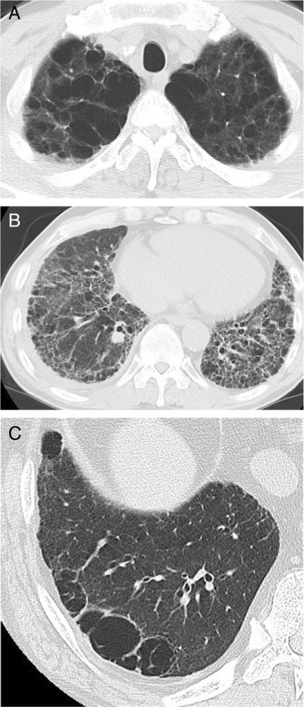 Representative computed tomography (CT) scans performed within 1Â month of death in a patient with combined pulmonary fibrosis and emphysema (CPFE) without lung cancer who died from pulmonary hypertension (A, B), and in another such patient with lung cancer who died from a non-respiratory cause (C). (A) Upper lobe showing centrilobular and paraseptal emphysema and bullae. (B) Lower lobe showing reticular opacities with peripheral and basal predominance and honeycombing, which was diagnosed as definite usual interstitial pneumonia (UIP) pattern. (C) Lower lobe showing thick-walled cystic lesions (TWCLs) larger than honeycombing with peripheral reticular opacities.