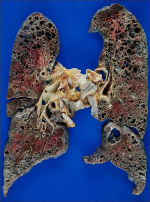 Gross photo showing marked upper lobe emphysema with fi