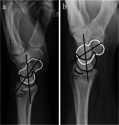 Normal alignment versus rotary subluxation of the scaph | Open-i