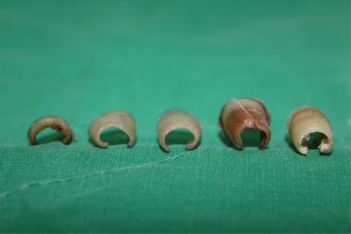 Correction of pincer nail deformity using dermal grafting. - Abstract -  Europe PMC