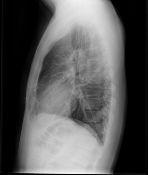 CHEST 2V FRONTAL/LATERAL XXXX, XXXX XXXX PM | Open-i