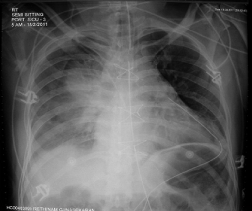 Chest X-ray on the first postoperative day showing righ | Open-i