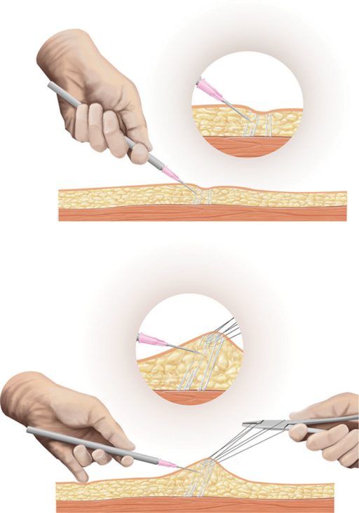 A, Simple subcision compared with combined upward sutur | Open-i