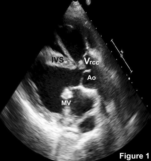 aorta.geo gmsh