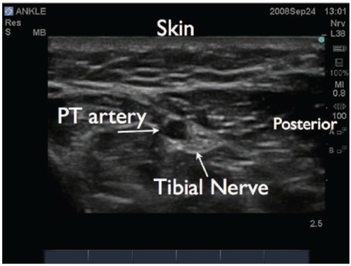 Ultrasound Image Of The Tibial Nerve In The Ankle The Open I